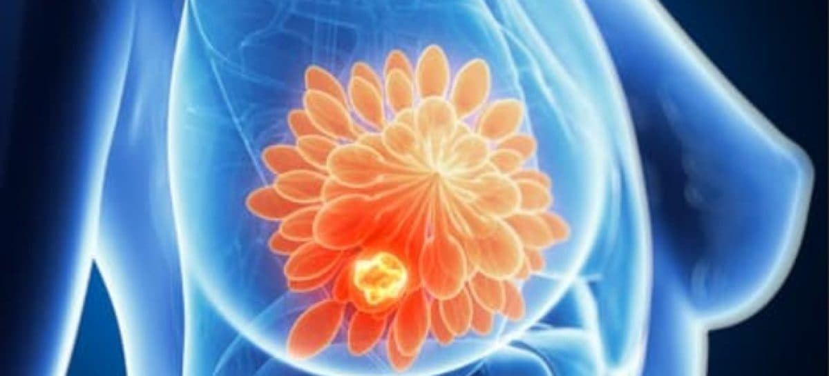 Spania a detectat 111 cazuri de cancer rar asociat implanturilor mamare