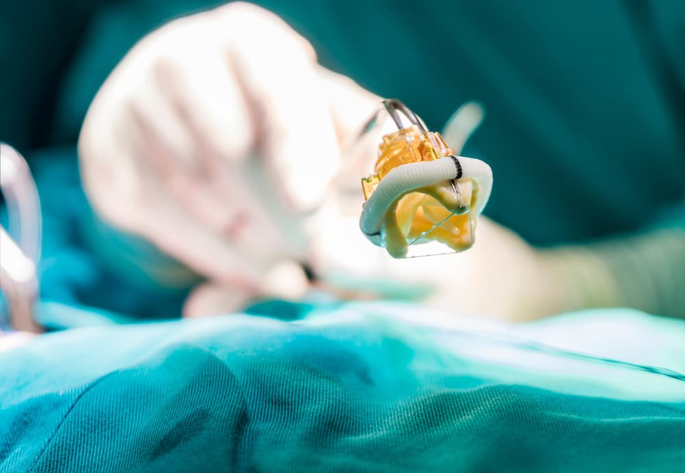 10 lucruri pe care pacienții trebuie să le știe despre procedura TAVI la clinicile Monza Ares (P)