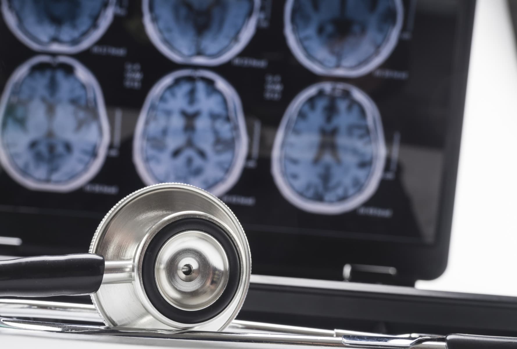 STUDIU: Interacţiunea dintre somn şi gene, asociată cu modificări cerebrale în stadiile incipiente ale bolii Alzheimer