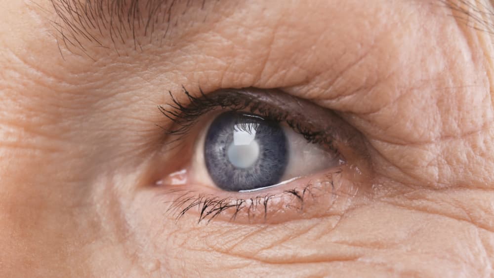 Eurostat: Cea mai frecventă procedură chirurgicală efectuată în spitalele din UE în 2023 a fost operaţia de cataractă / România, cea mai mică rată la 100.000 de locuitori / Peste un milion de cezariene în UE, cele mai multe în Cipru şi România