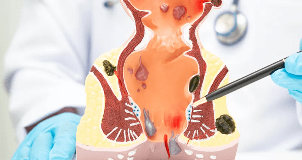 Chirurgia robotică, șansa unei femei cu cancer rectal metastatic. Medic: „Evităm colostomele în mai mult de jumătate din cazuri”