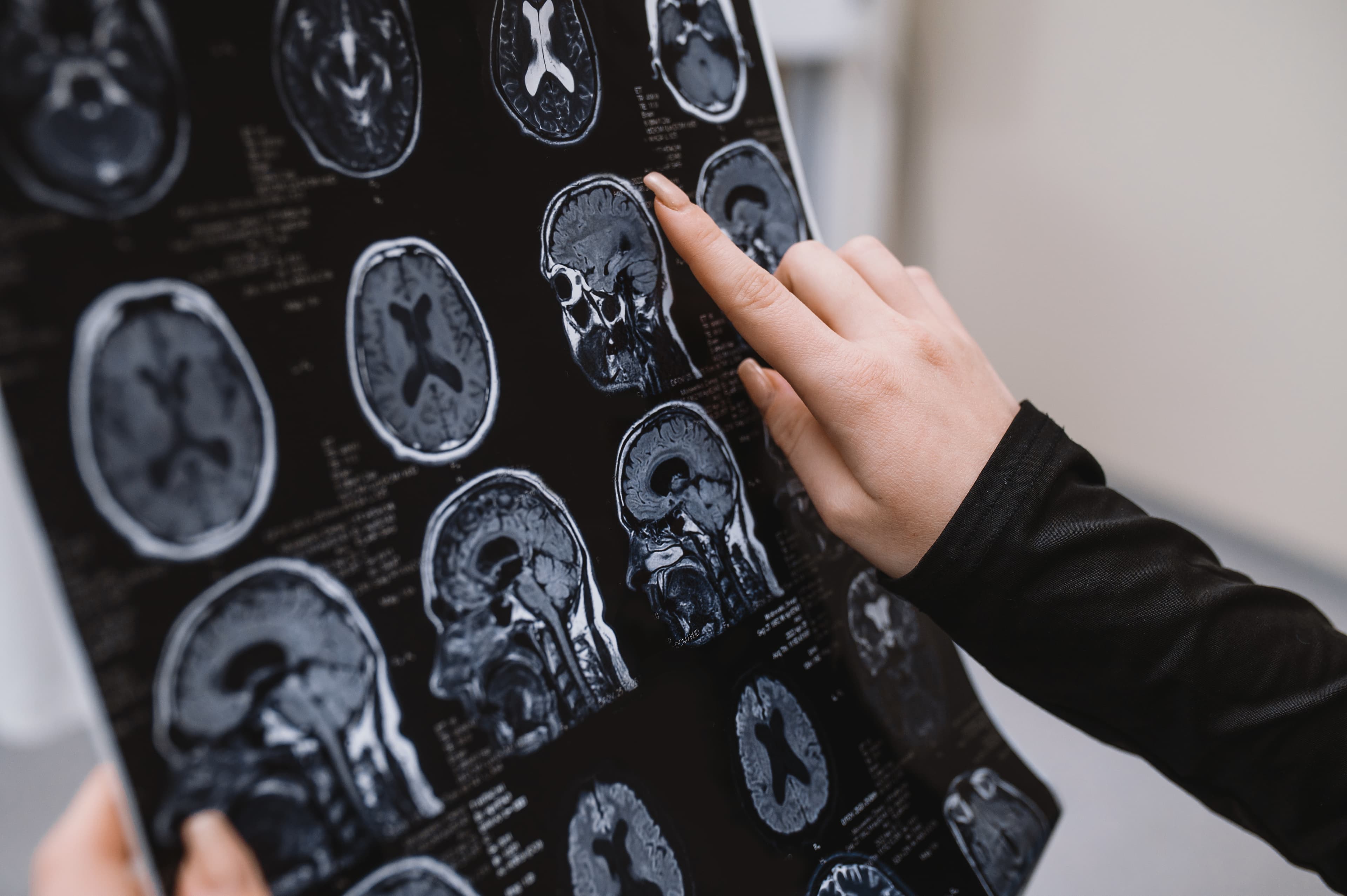 Demenţa începe cu „gafe” aparent banale. Medic neurolog: „Pacienţii ajung, din păcate, când boala este deja coaptă”