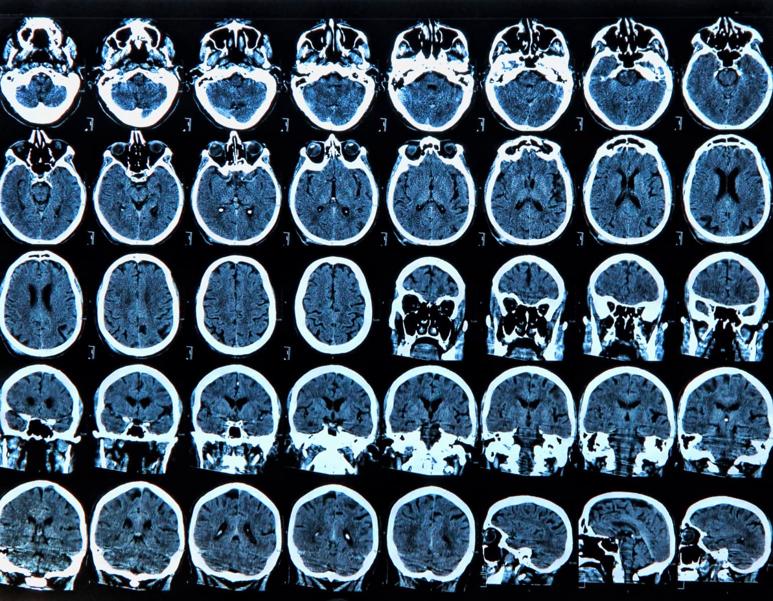 Descoperire japoneză. Vitaminele B pot stopa progresia bolii Parkinson