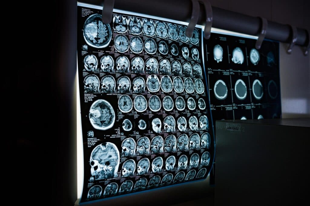 O femeie s-a dus la medic susținând că aude voci care îi spun că are o tumoare cerebrală. Chiar avea